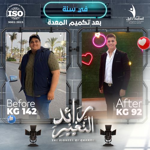 ما هي تكميم المعدة